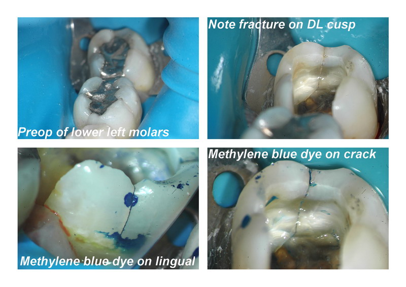 SB cracked tooth pg 1_resize.jpg